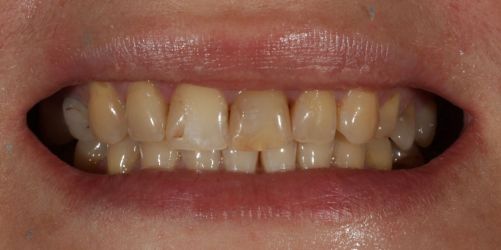 Восстановление зубов верхней челюсти керамическими винирами E.max и отбеливание Zoom3 - фото №1