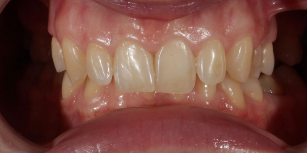 Восстановление зубов верхней челюсти керамическими винирами E.max и отбеливание Zoom3 - фото №1