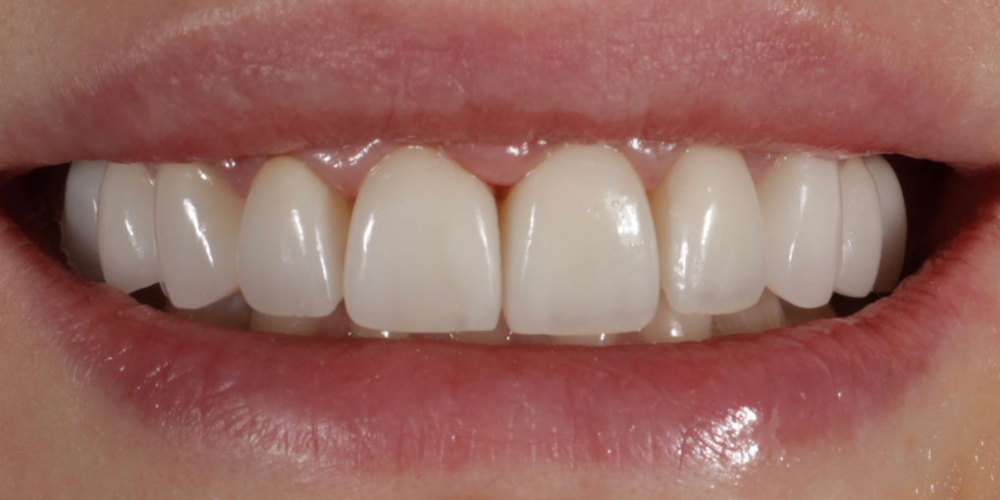 Восстановление зубов верхней челюсти керамическими винирами E.max и отбеливание Zoom3 - фото №2