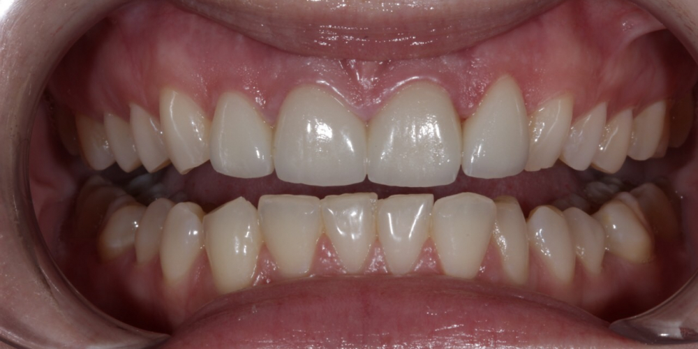 Восстановление резцов верхней челюсти керамическими винирами E.max и отбеливание Zoom3 - фото №2
