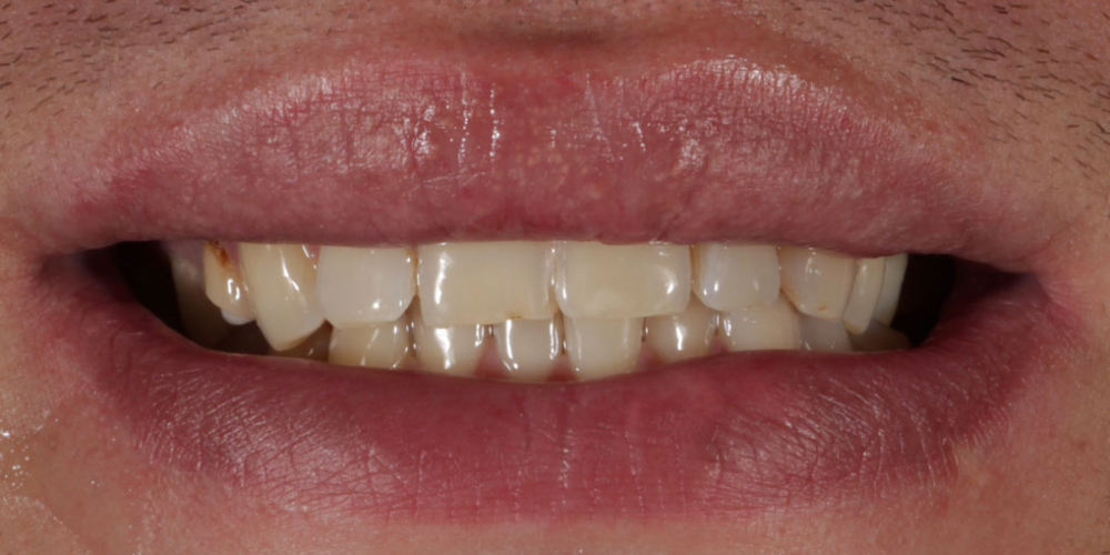Восстановление зубов верхней и нижней челюсти керамическими винирами E.max - фото №1