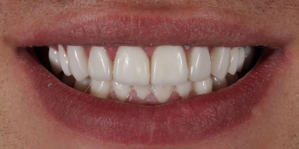 Восстановление зубов верхней и нижней челюсти керамическими винирами E.max - фото №2