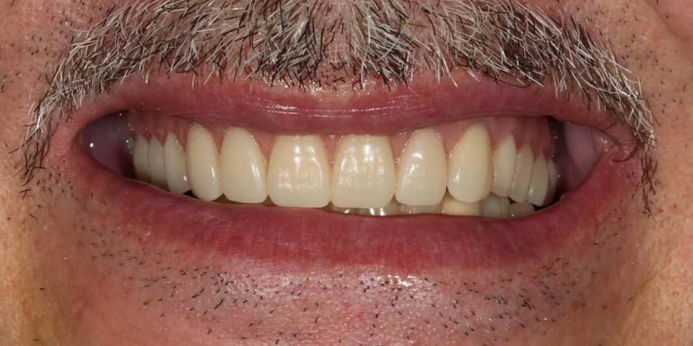 Протезирование условно-съёмными протезами на верхней челюсти (балочное соединение на 4 имплантатах) - фото №2