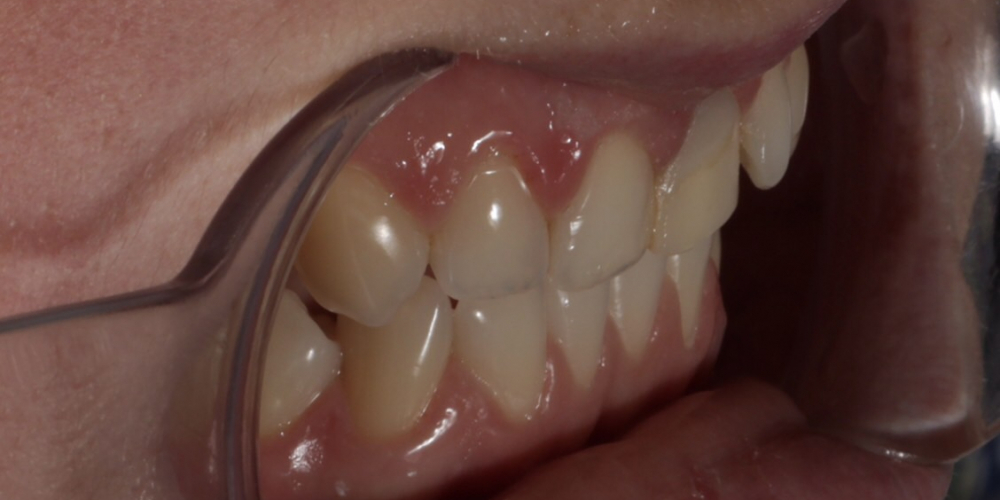 Эстетическое преобразование передних зубов верхней челюсти - фото №1