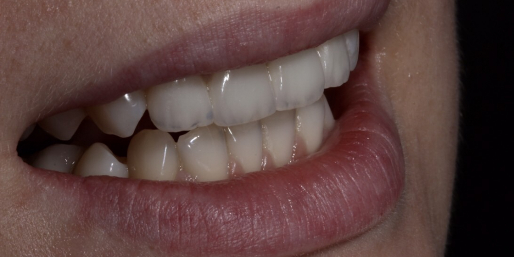 Эстетическое преобразование передних зубов верхней челюсти - фото №2