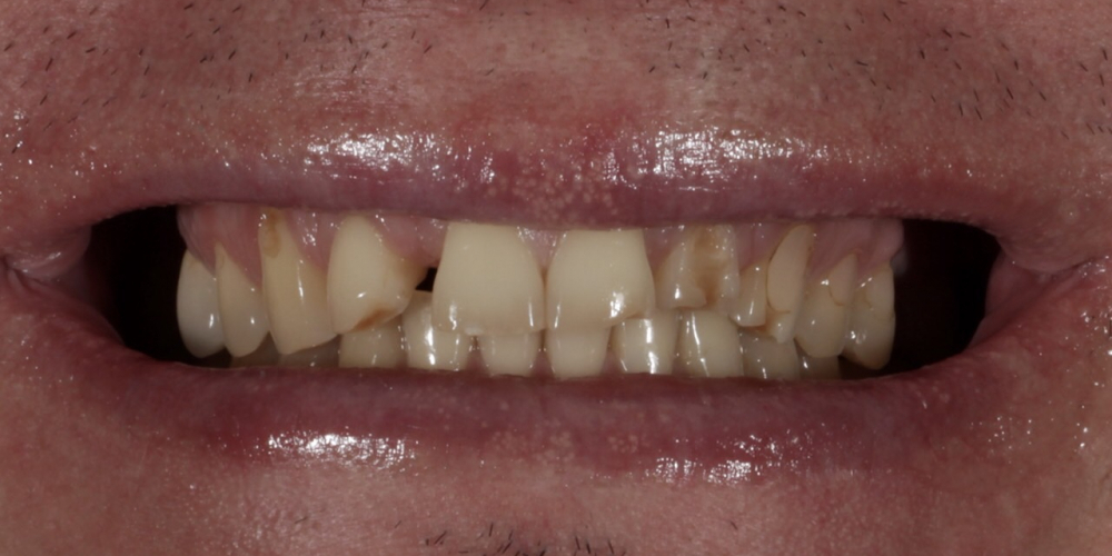 Установка 2 иплантантов Straumann и восстановление формы, функции и эстетики зубов винирами - фото №1
