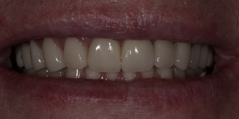 Установка 2 иплантантов Straumann и восстановление формы, функции и эстетики зубов винирами - фото №2