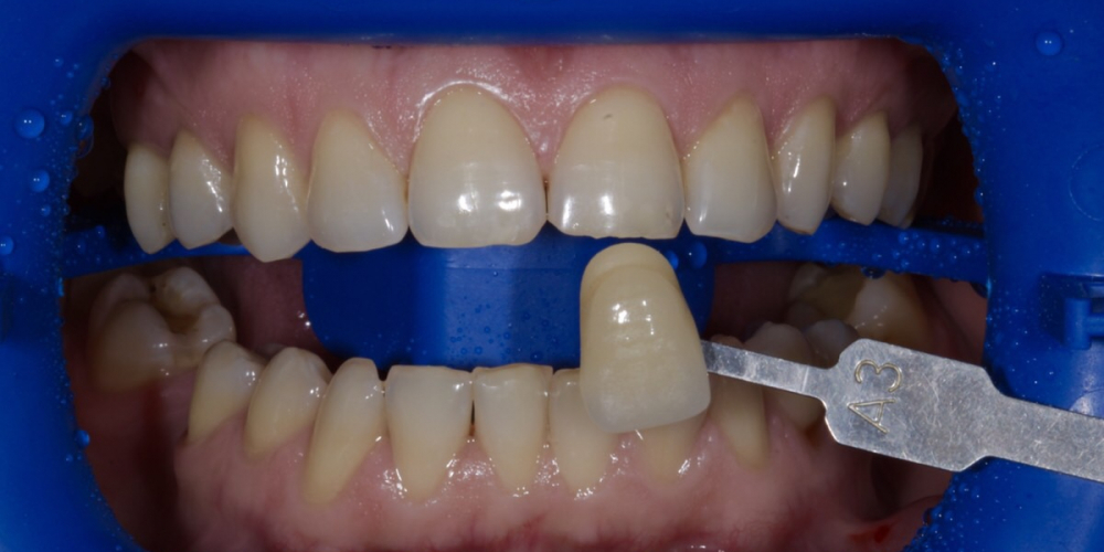 Гигиена полости рта с последующей процедурой профессионального кабинетного отбеливания системой Zoom - фото №1
