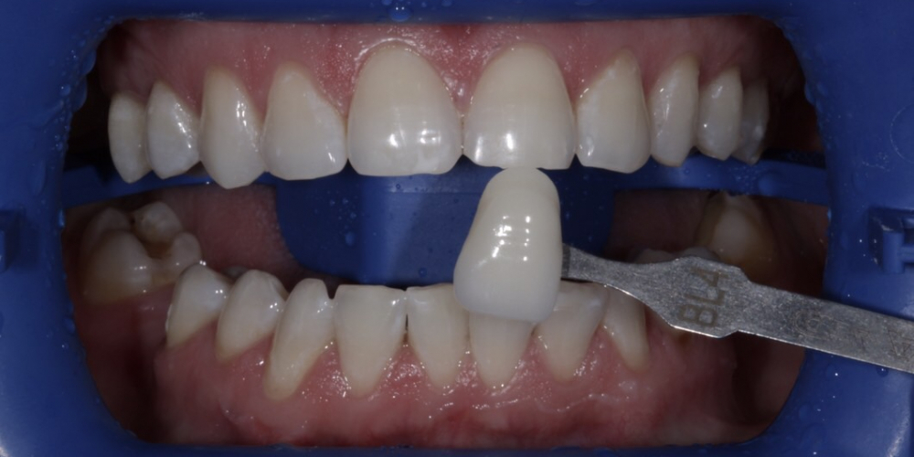 Гигиена полости рта с последующей процедурой профессионального кабинетного отбеливания системой Zoom - фото №2