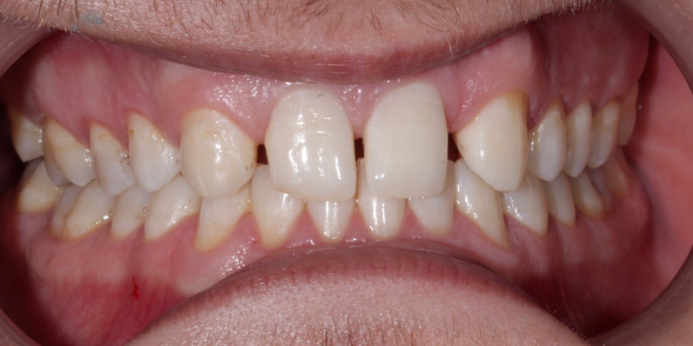 Изменение формы зубов верхней челюсти, коррекция цвета, восстановление функции - фото №1