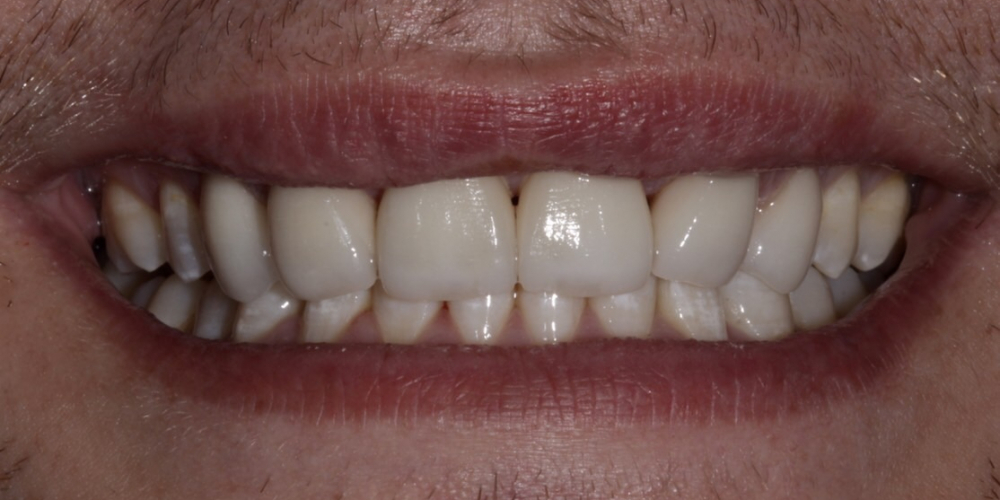 Изменение формы зубов верхней челюсти, коррекция цвета, восстановление функции - фото №2