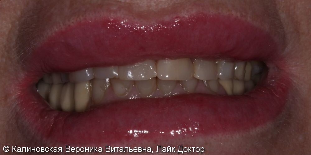 Неудовлетворительная эстетика: цвет зубов верхней и нижней челюсти - фото №1