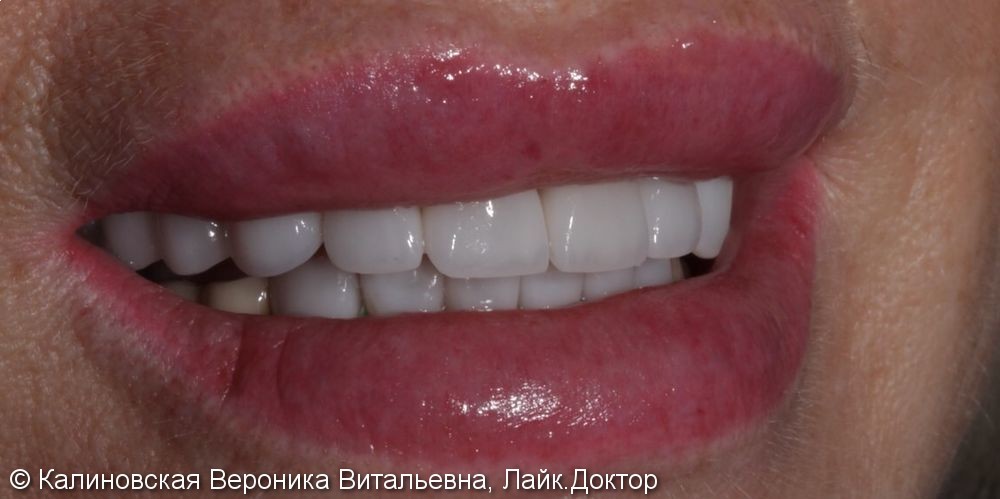 Неудовлетворительная эстетика: цвет зубов верхней и нижней челюсти - фото №2