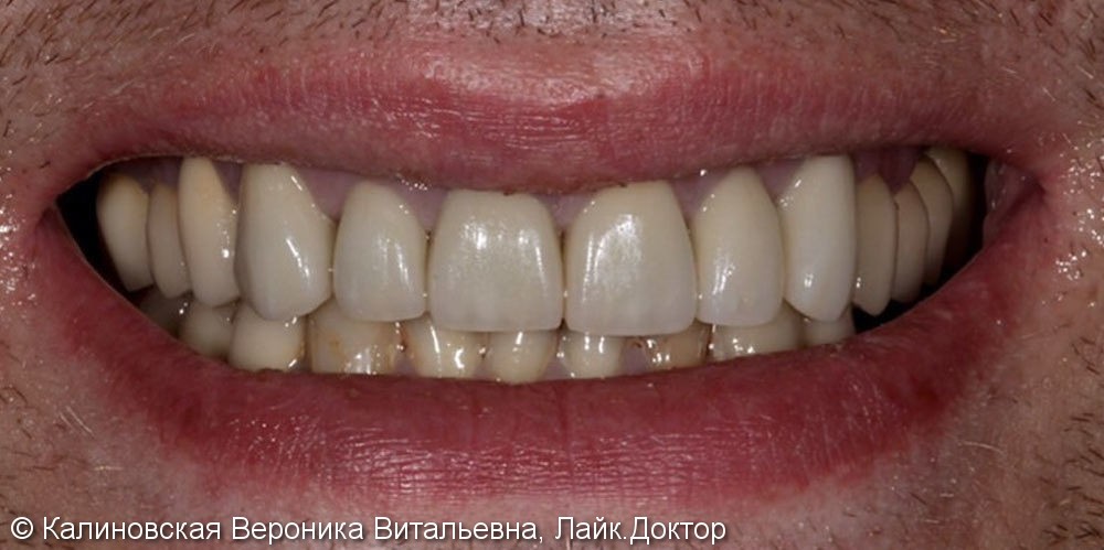 Жалобы на неудовлетворительную эстетику зубов - фото №2