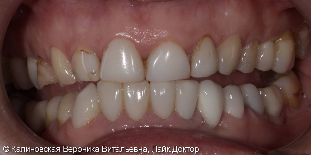 Керамические виниры Е-макс, 7 шт на передние зубы, до и после - фото №1