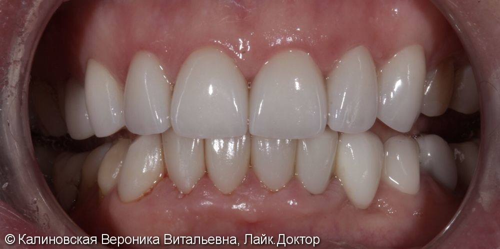 Керамические виниры Е-макс, 7 шт на передние зубы, до и после - фото №2