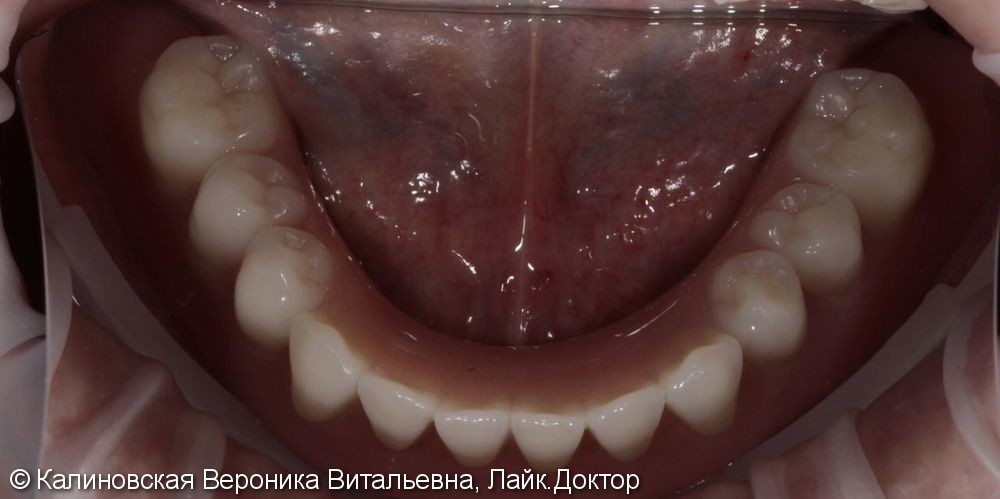 Протезирование условно-съёмными протезами на нижней челюсти (балочное соединение на 4 имплантатах) - фото №3