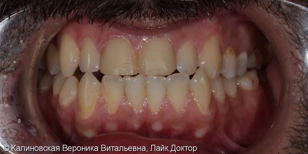 Эстетическое восстановление передних зубов верхней челюсти - фото №1