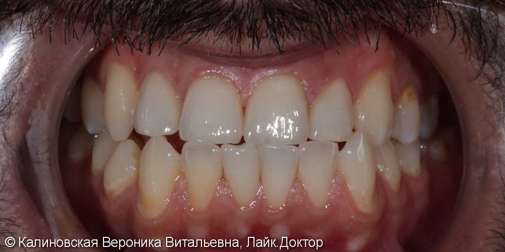 Эстетическое восстановление передних зубов верхней челюсти - фото №2