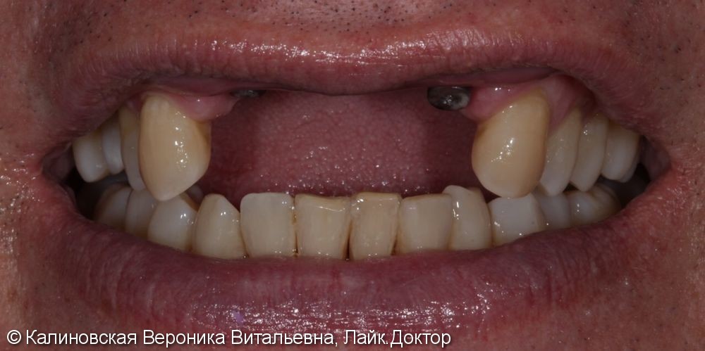 Восстановление передних зубов на верхней челюсти - фото №1