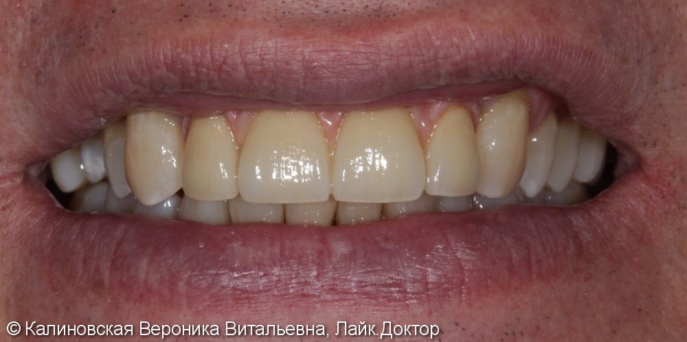Восстановление передних зубов на верхней челюсти - фото №2