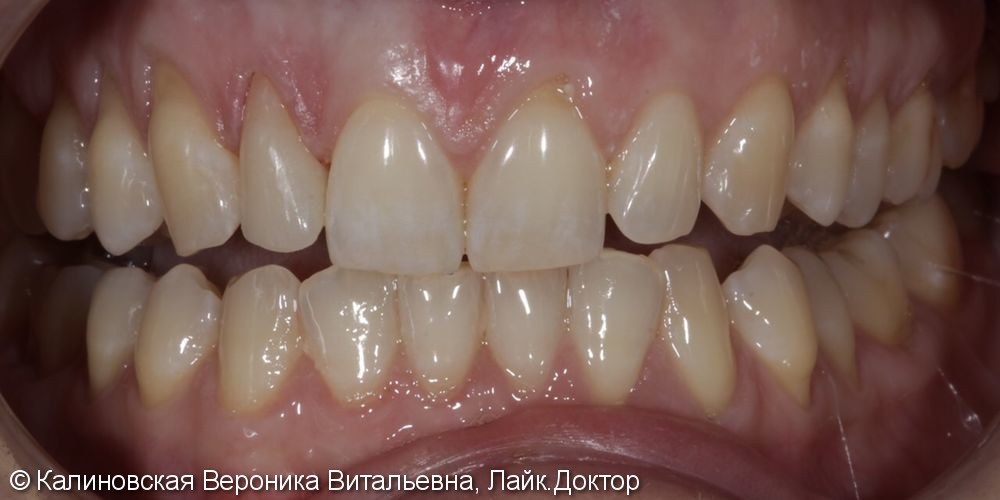 Восстановление 12 зуба виниром Emax - фото №2