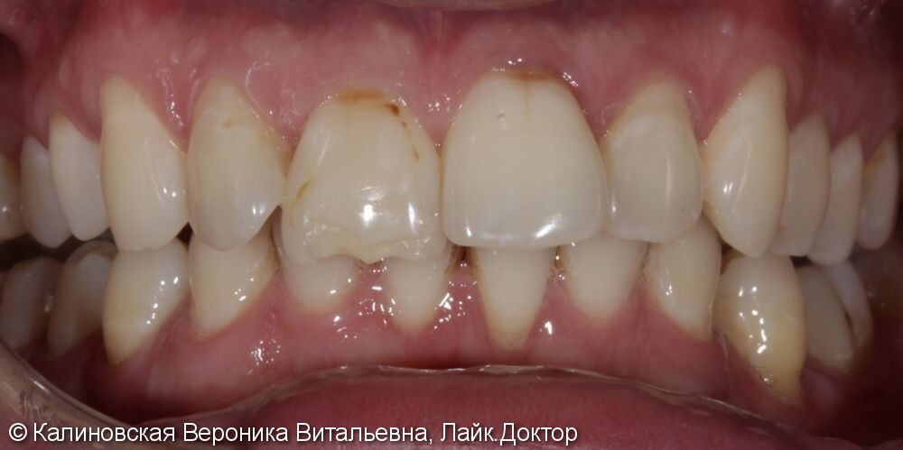 Восстановление передних зубов двумя керамическими винирами, до и после - фото №1