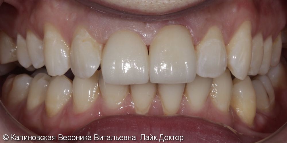 Восстановление передних зубов двумя керамическими винирами, до и после - фото №2