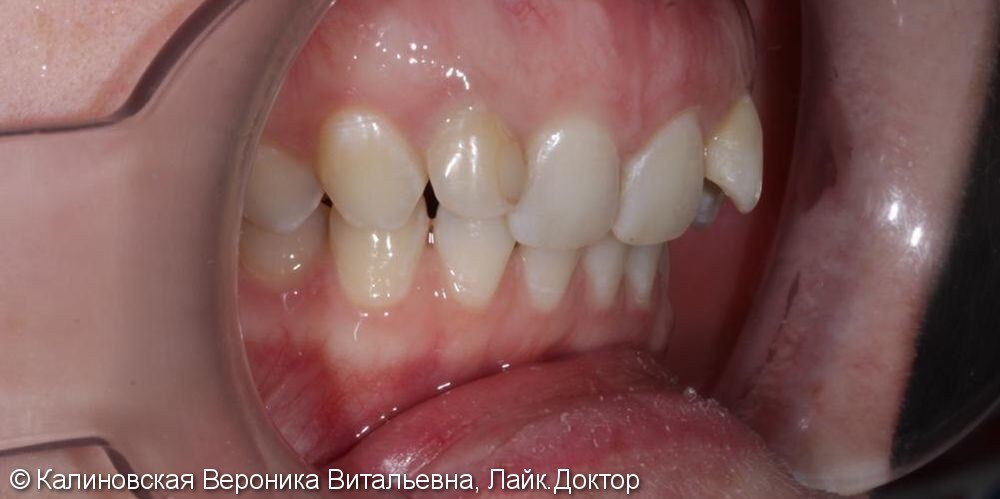 Восстановление зубов винирами Еmax, до и после - фото №1