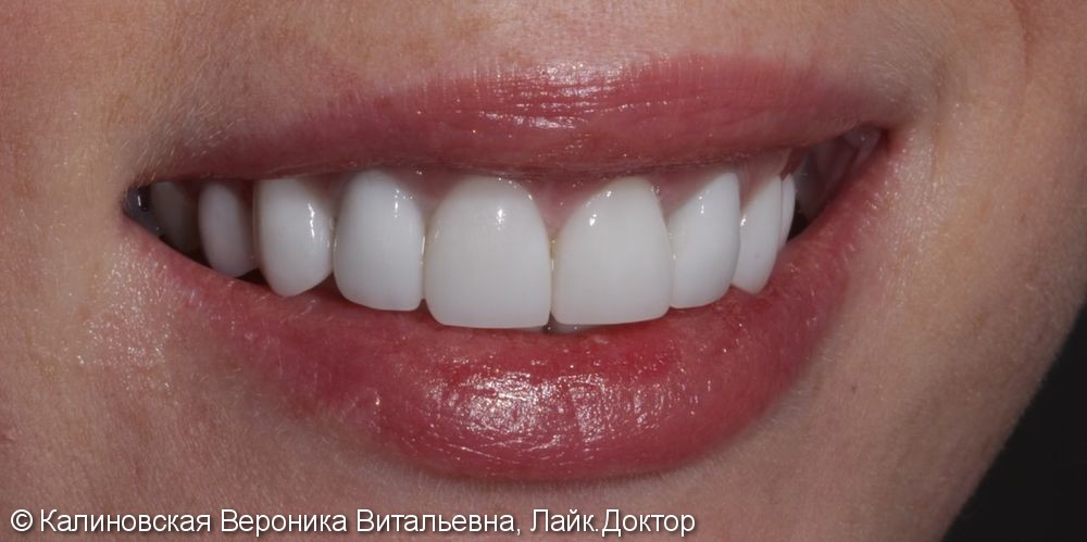 Восстановление зубов винирами Еmax, до и после - фото №4