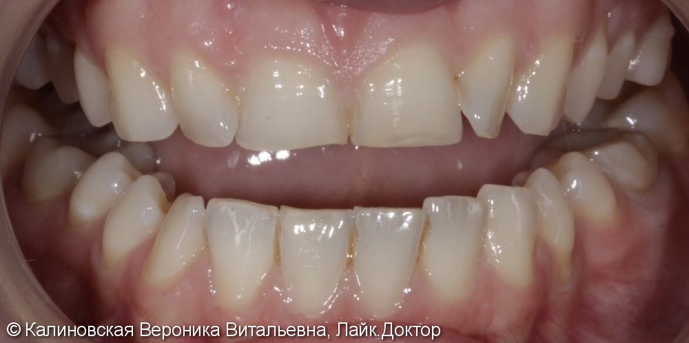 Восстановление зубов 4-мя винирами Еmax, до и после - фото №1