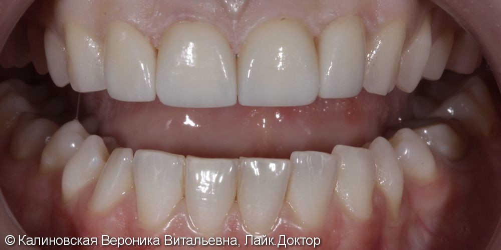 Восстановление зубов 4-мя винирами Еmax, до и после - фото №2