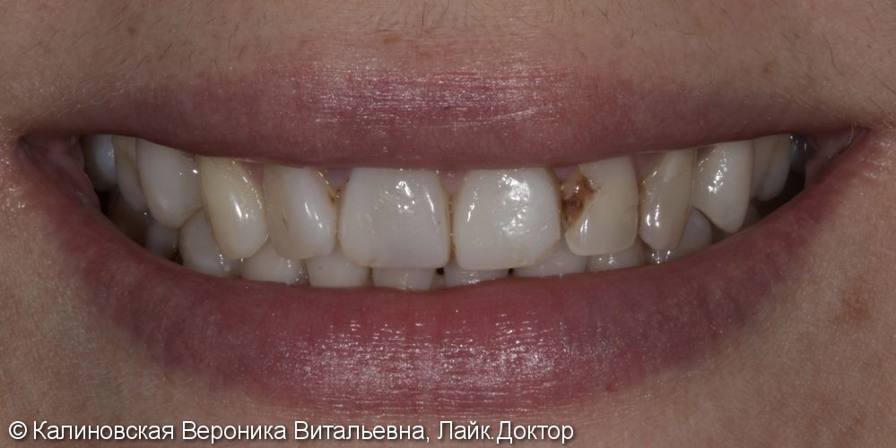 Восстановление винирами Emax зубов верхней и нижней челюстей - фото №1
