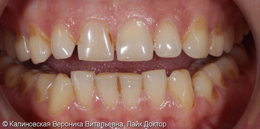 Восстановление зубов верхней и нижней челюстей винирами Еmax - фото №1