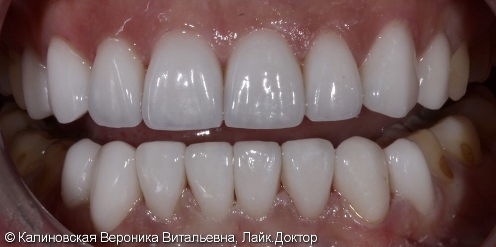 Восстановление зубов верхней и нижней челюстей винирами Еmax - фото №2