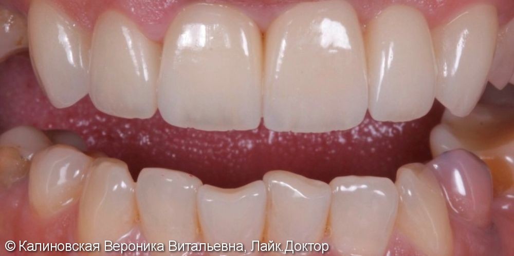 Восстановление зубов винирами Emax и отбеливание ZOOM 4 - фото №2