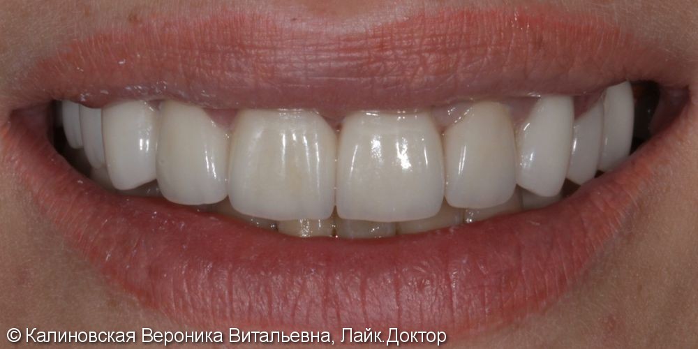 Восстановление зубов на верхней челюсти - фото №2