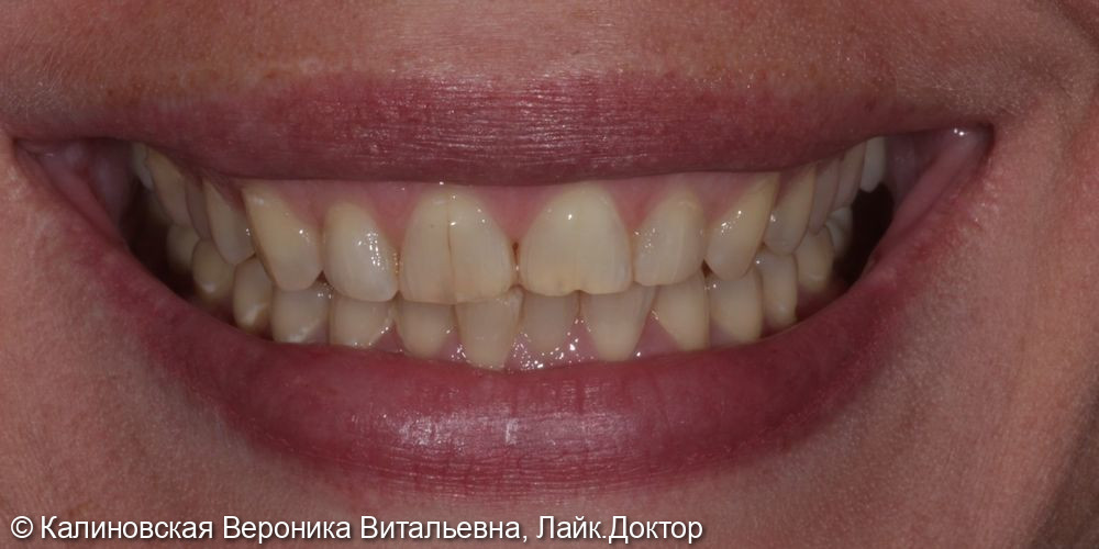 Восстановление зубов на верхней челюсти Емах и отбеливание Zoom4 - фото №1