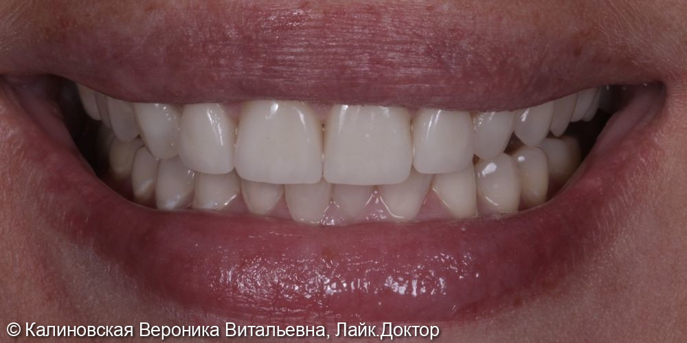 Восстановление зубов на верхней челюсти Емах и отбеливание Zoom4 - фото №2