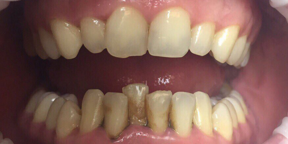 Результат снятия темного налета на зубах - фото №1
