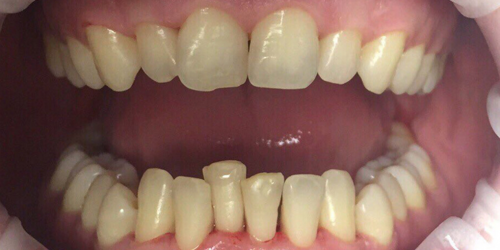 Результат снятия темного налета на зубах - фото №2