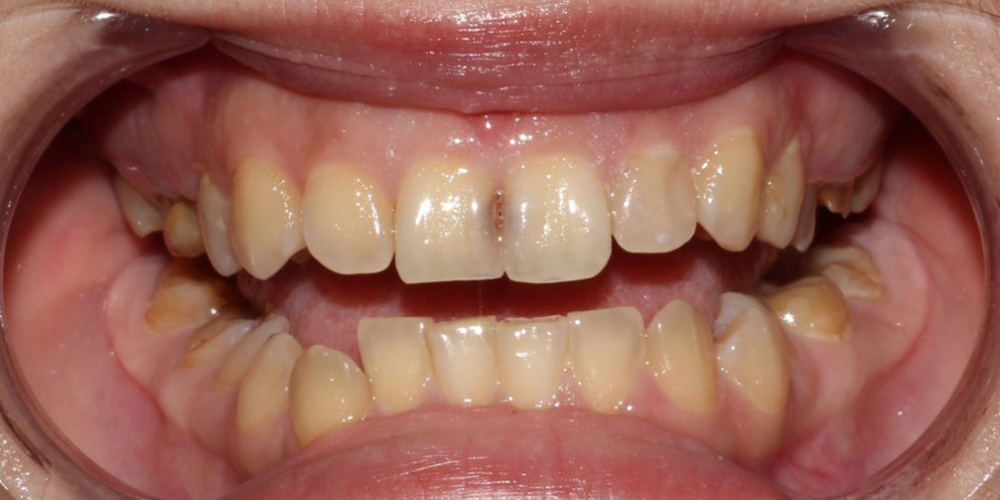 Устранение тёмных пятен между передними верхними зубами - фото №1