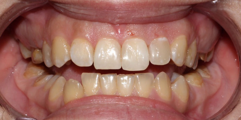 Устранение тёмных пятен между передними верхними зубами - фото №2