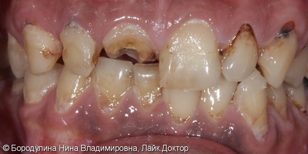Восстановление центральных зубов верхней челюсти - фото №1
