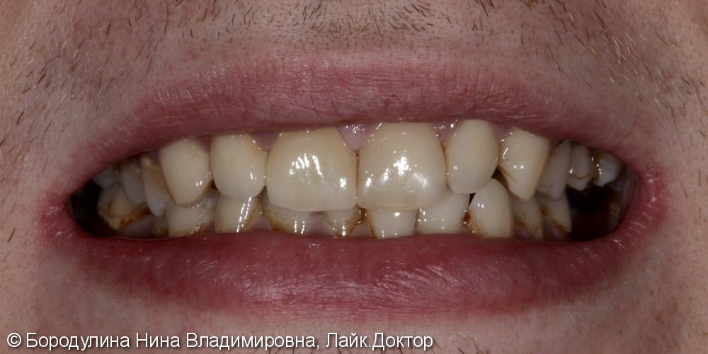 Восстановление центральных зубов верхней челюсти - фото №2