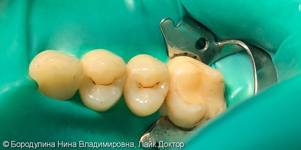 Лечение кариеса жевательных зубов 2.4, 2.5 - фото №1