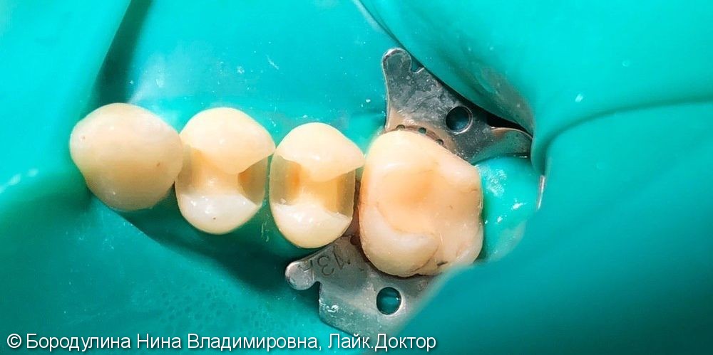 Лечение кариеса жевательных зубов 2.4, 2.5 - фото №2