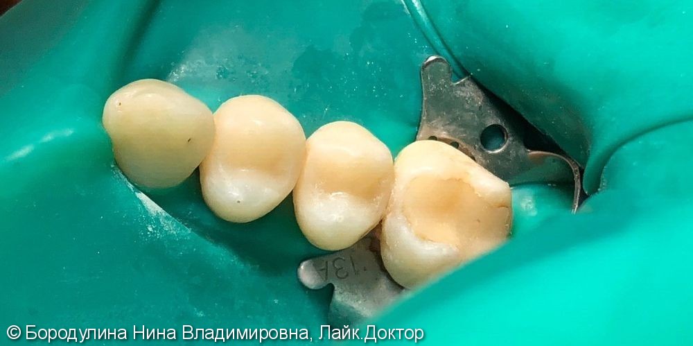 Лечение кариеса жевательных зубов 2.4, 2.5 - фото №3