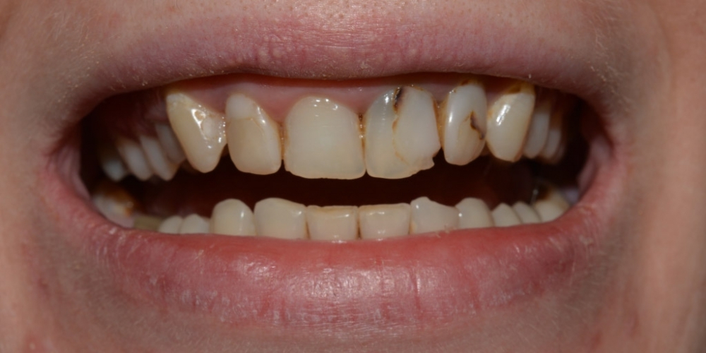 Протезирование цельнокерамическими (E.max) коронками передних зубов - фото №1