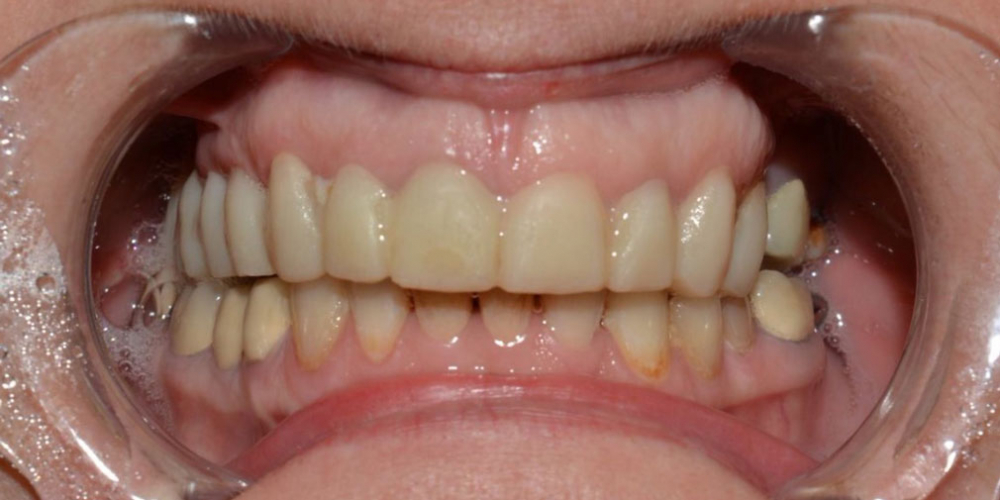 Восстановление формы и эстетики всех зубов коронками и винирами Е-max - фото №1